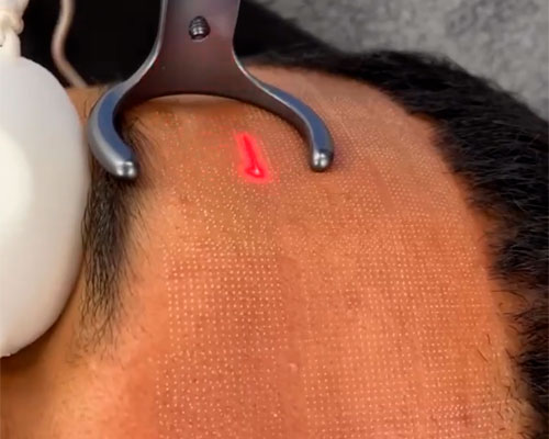 3d-co2-fraction-laser