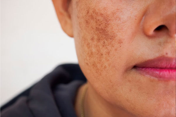 melasma
